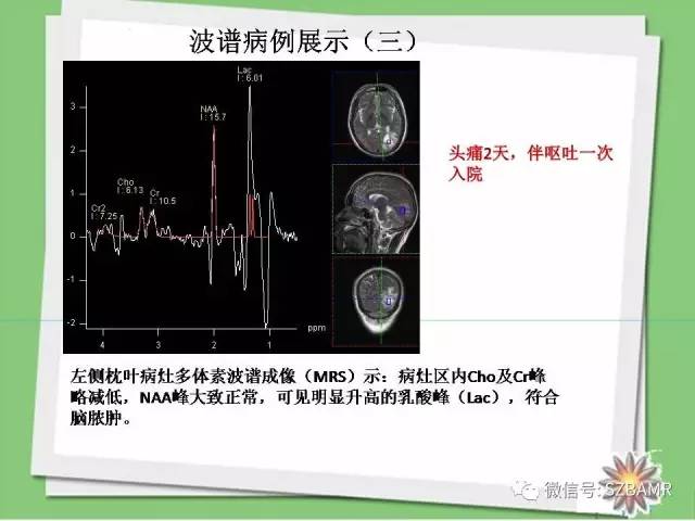 【PPT】波谱扫描技术及病例图片展示