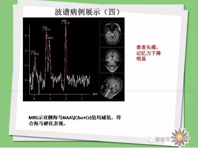 【PPT】波谱扫描技术及病例图片展示