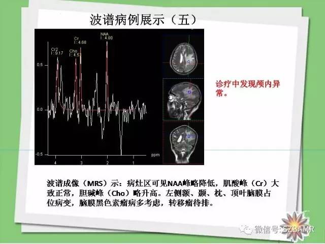 【PPT】波谱扫描技术及病例图片展示