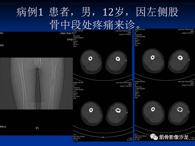 郎格汉斯组织细胞增生症(LCH)的影像学诊断 郎格汉斯组织细胞增生症(LCH)的影像学诊断