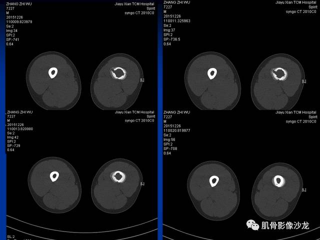 郎格汉斯组织细胞增生症(LCH)的影像学诊断 郎格汉斯组织细胞增生症(LCH)的影像学诊断