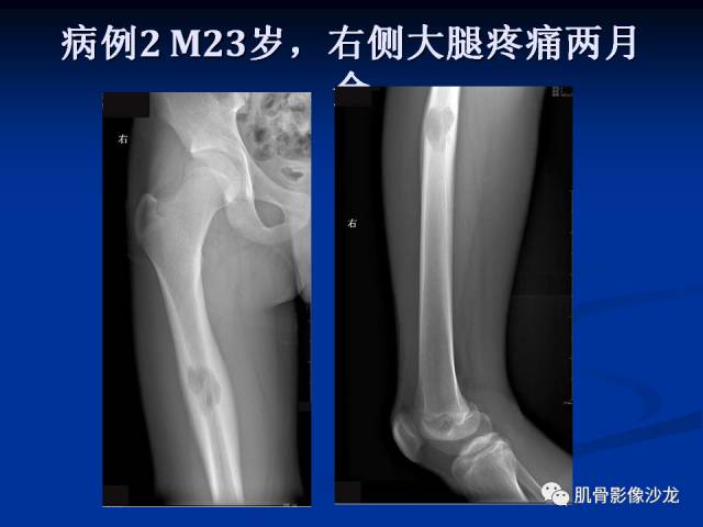 郎格汉斯组织细胞增生症(LCH)的影像学诊断 郎格汉斯组织细胞增生症(LCH)的影像学诊断