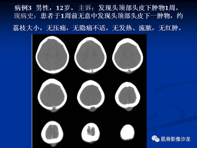 郎格汉斯组织细胞增生症(LCH)的影像学诊断 郎格汉斯组织细胞增生症(LCH)的影像学诊断
