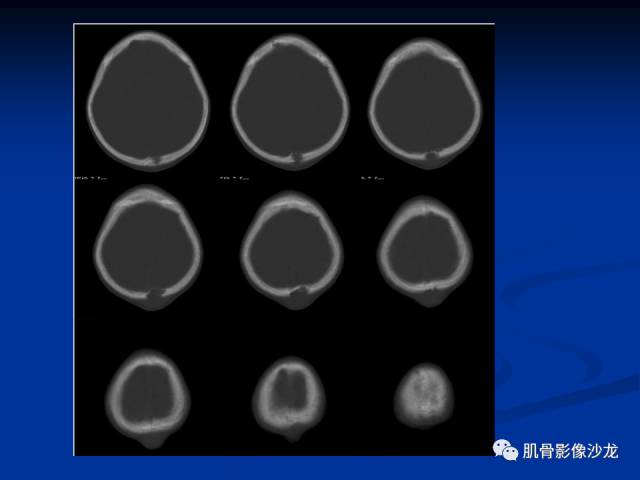 郎格汉斯组织细胞增生症(LCH)的影像学诊断 郎格汉斯组织细胞增生症(LCH)的影像学诊断