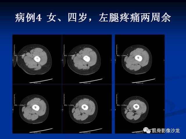 郎格汉斯组织细胞增生症(LCH)的影像学诊断 郎格汉斯组织细胞增生症(LCH)的影像学诊断