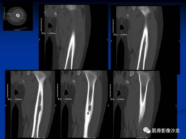 郎格汉斯组织细胞增生症(LCH)的影像学诊断 郎格汉斯组织细胞增生症(LCH)的影像学诊断