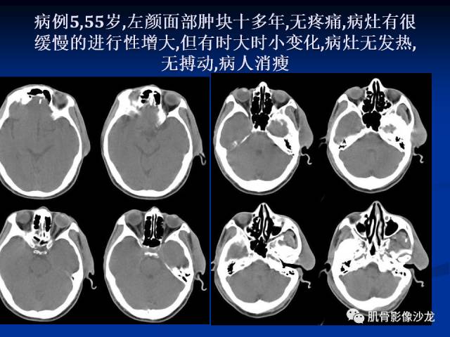 郎格汉斯组织细胞增生症(LCH)的影像学诊断 郎格汉斯组织细胞增生症(LCH)的影像学诊断