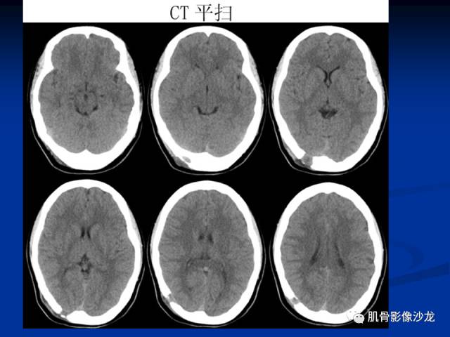 郎格汉斯组织细胞增生症(LCH)的影像学诊断 郎格汉斯组织细胞增生症(LCH)的影像学诊断