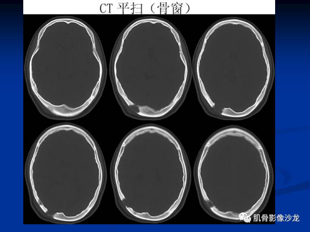 郎格汉斯组织细胞增生症(LCH)的影像学诊断 郎格汉斯组织细胞增生症(LCH)的影像学诊断