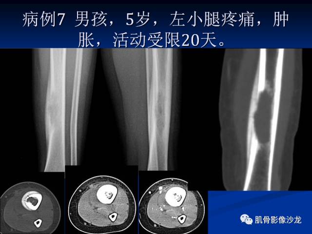 郎格汉斯组织细胞增生症(LCH)的影像学诊断 郎格汉斯组织细胞增生症(LCH)的影像学诊断