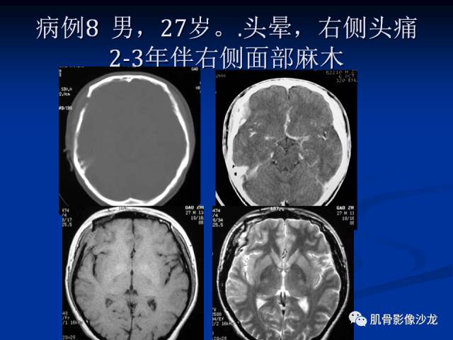 郎格汉斯组织细胞增生症(LCH)的影像学诊断 郎格汉斯组织细胞增生症(LCH)的影像学诊断