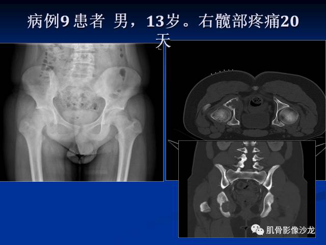 郎格汉斯组织细胞增生症(LCH)的影像学诊断 郎格汉斯组织细胞增生症(LCH)的影像学诊断