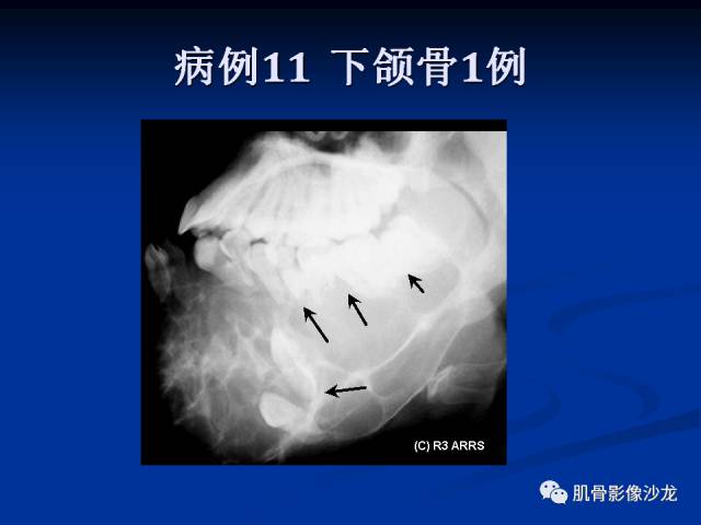 郎格汉斯组织细胞增生症(LCH)的影像学诊断 郎格汉斯组织细胞增生症(LCH)的影像学诊断