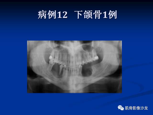 郎格汉斯组织细胞增生症(LCH)的影像学诊断 郎格汉斯组织细胞增生症(LCH)的影像学诊断