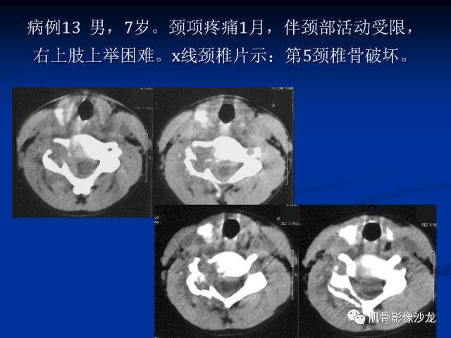 郎格汉斯组织细胞增生症(LCH)的影像学诊断 郎格汉斯组织细胞增生症(LCH)的影像学诊断