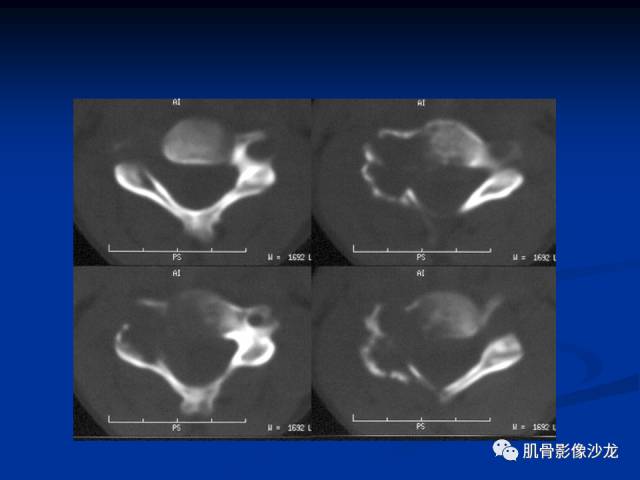 郎格汉斯组织细胞增生症(LCH)的影像学诊断 郎格汉斯组织细胞增生症(LCH)的影像学诊断