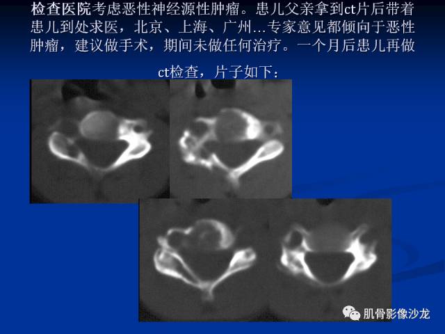 郎格汉斯组织细胞增生症(LCH)的影像学诊断 郎格汉斯组织细胞增生症(LCH)的影像学诊断
