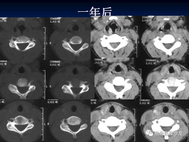 郎格汉斯组织细胞增生症(LCH)的影像学诊断 郎格汉斯组织细胞增生症(LCH)的影像学诊断