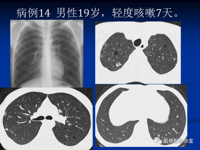 郎格汉斯组织细胞增生症(LCH)的影像学诊断 郎格汉斯组织细胞增生症(LCH)的影像学诊断