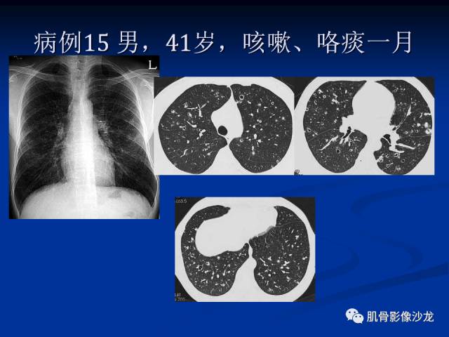 郎格汉斯组织细胞增生症(LCH)的影像学诊断 郎格汉斯组织细胞增生症(LCH)的影像学诊断