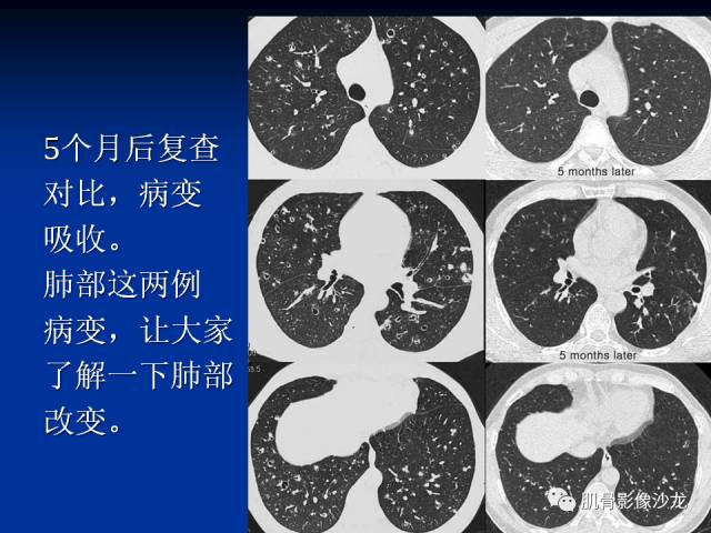 郎格汉斯组织细胞增生症(LCH)的影像学诊断 郎格汉斯组织细胞增生症(LCH)的影像学诊断