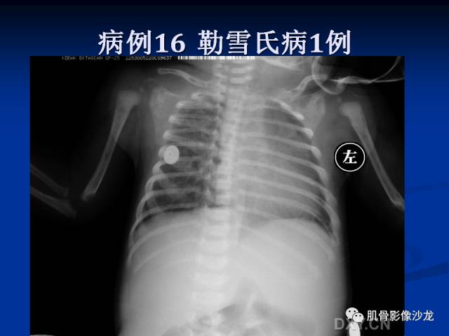 郎格汉斯组织细胞增生症(LCH)的影像学诊断 郎格汉斯组织细胞增生症(LCH)的影像学诊断