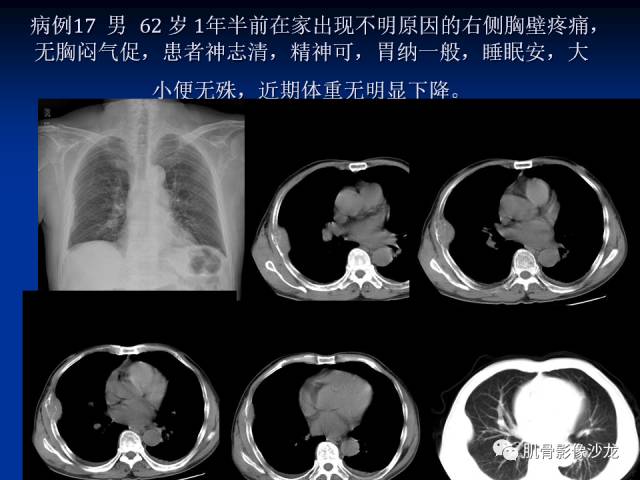 郎格汉斯组织细胞增生症(LCH)的影像学诊断 郎格汉斯组织细胞增生症(LCH)的影像学诊断