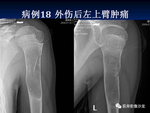 郎格汉斯组织细胞增生症(LCH)的影像学诊断 郎格汉斯组织细胞增生症(LCH)的影像学诊断