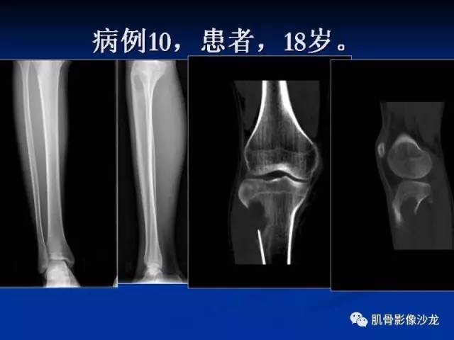 郎格汉斯组织细胞增生症(LCH)的影像学诊断 郎格汉斯组织细胞增生症(LCH)的影像学诊断