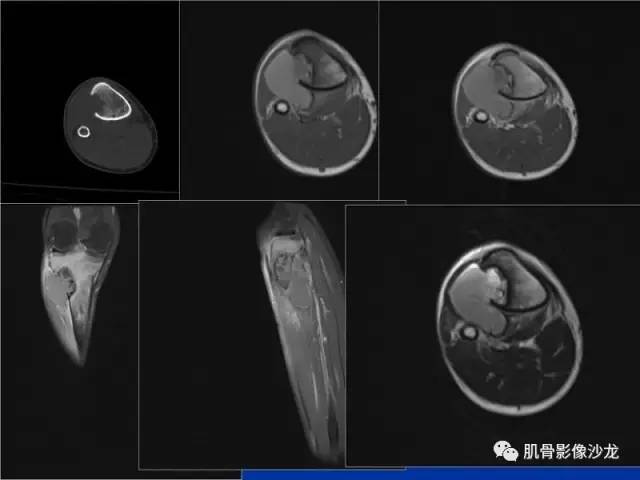 郎格汉斯组织细胞增生症(LCH)的影像学诊断 郎格汉斯组织细胞增生症(LCH)的影像学诊断