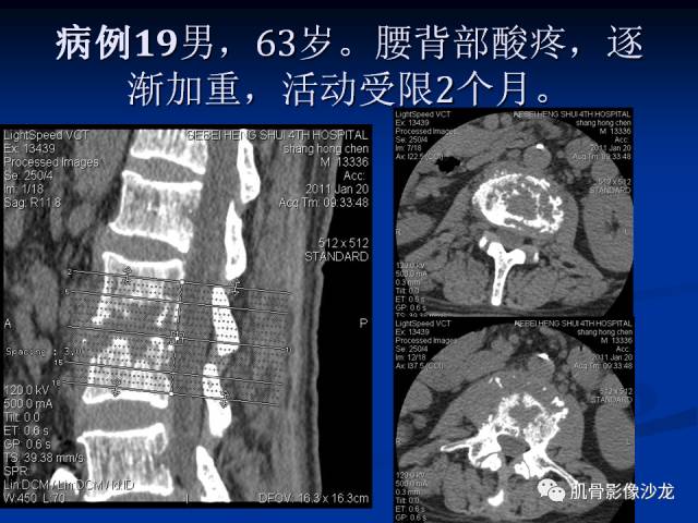 郎格汉斯组织细胞增生症(LCH)的影像学诊断 郎格汉斯组织细胞增生症(LCH)的影像学诊断