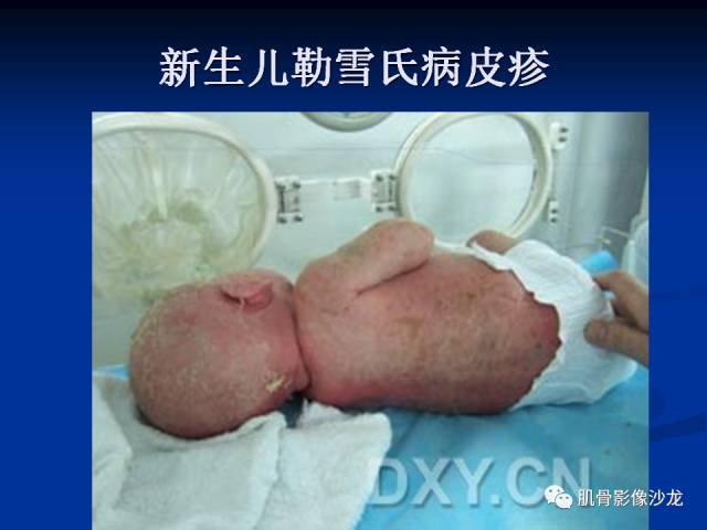 郎格汉斯组织细胞增生症(LCH)的影像学诊断 郎格汉斯组织细胞增生症(LCH)的影像学诊断