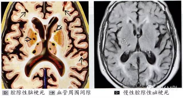 磁共振脑白质区内斑点影解读 磁共振脑白质区内斑点影解读