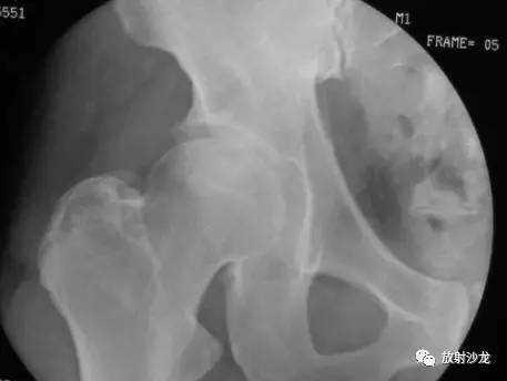 从X光线、CT的影像中了解股骨头坏死每期的病变 从X光线、CT的影像中了解股骨头坏死每期的病变