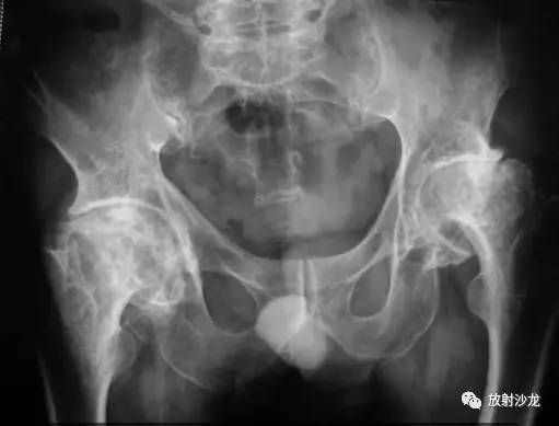 从X光线、CT的影像中了解股骨头坏死每期的病变