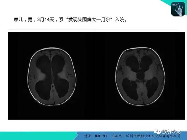 【病例】小儿后颅凹巨大蛛网膜囊肿1例MR