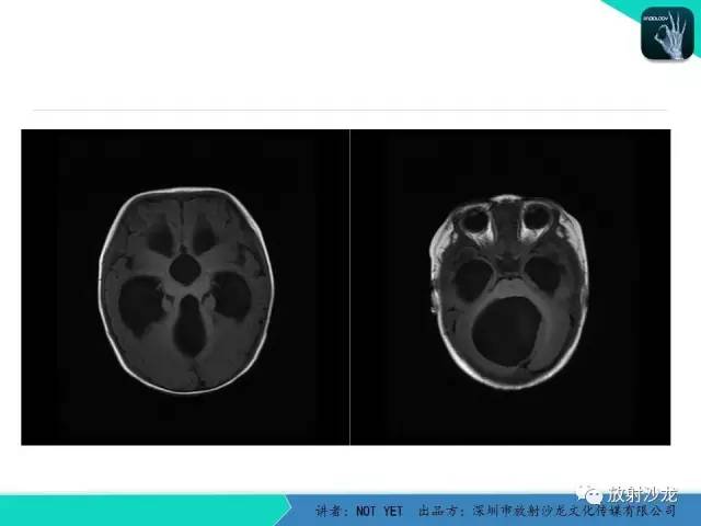 【病例】小儿后颅凹巨大蛛网膜囊肿1例MR