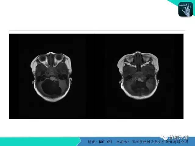 【病例】小儿后颅凹巨大蛛网膜囊肿1例MR