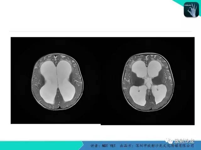 【病例】小儿后颅凹巨大蛛网膜囊肿1例MR