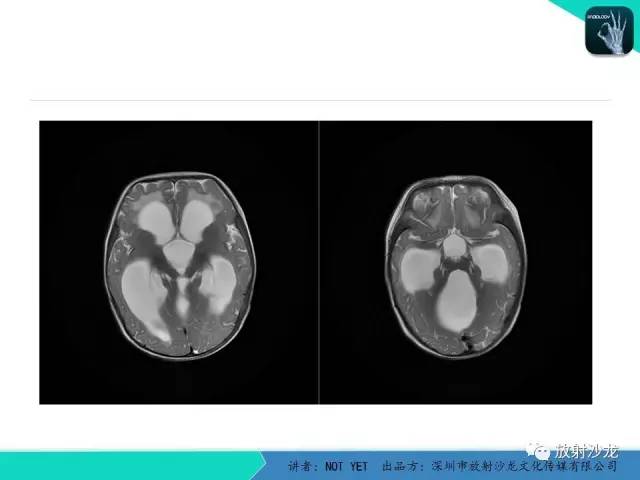 【病例】小儿后颅凹巨大蛛网膜囊肿1例MR