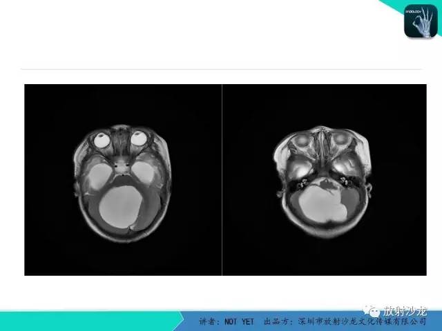 【病例】小儿后颅凹巨大蛛网膜囊肿1例MR
