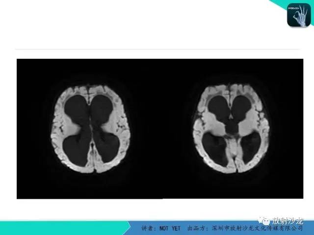 【病例】小儿后颅凹巨大蛛网膜囊肿1例MR