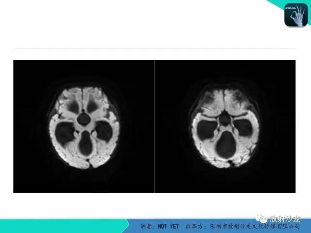 【病例】小儿后颅凹巨大蛛网膜囊肿1例MR