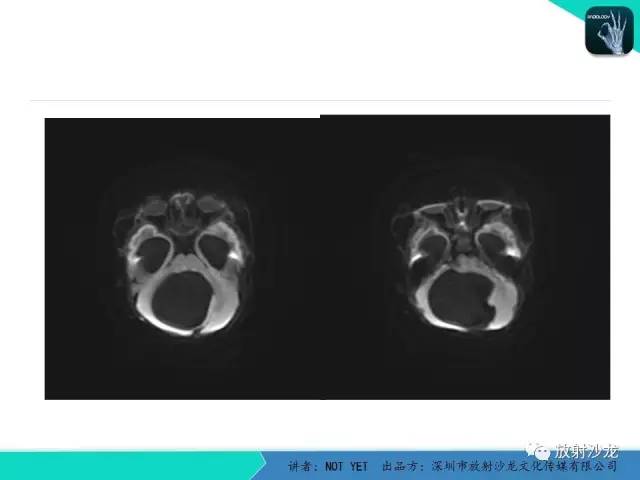 【病例】小儿后颅凹巨大蛛网膜囊肿1例MR
