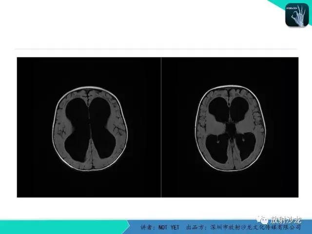 【病例】小儿后颅凹巨大蛛网膜囊肿1例MR