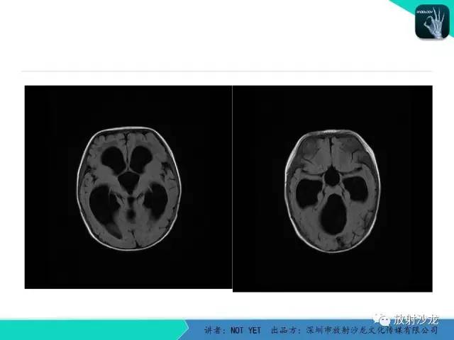 【病例】小儿后颅凹巨大蛛网膜囊肿1例MR