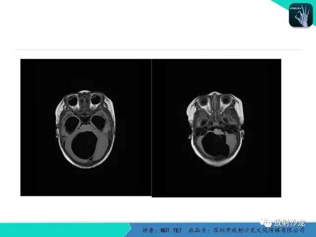 【病例】小儿后颅凹巨大蛛网膜囊肿1例MR