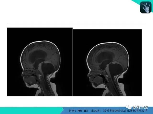 【病例】小儿后颅凹巨大蛛网膜囊肿1例MR