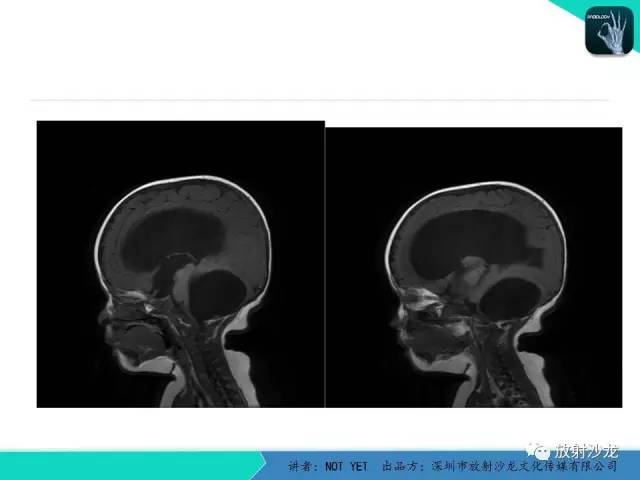 【病例】小儿后颅凹巨大蛛网膜囊肿1例MR