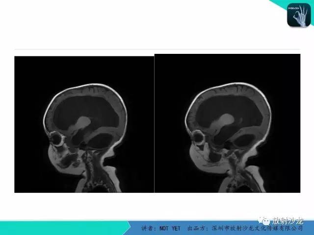 【病例】小儿后颅凹巨大蛛网膜囊肿1例MR
